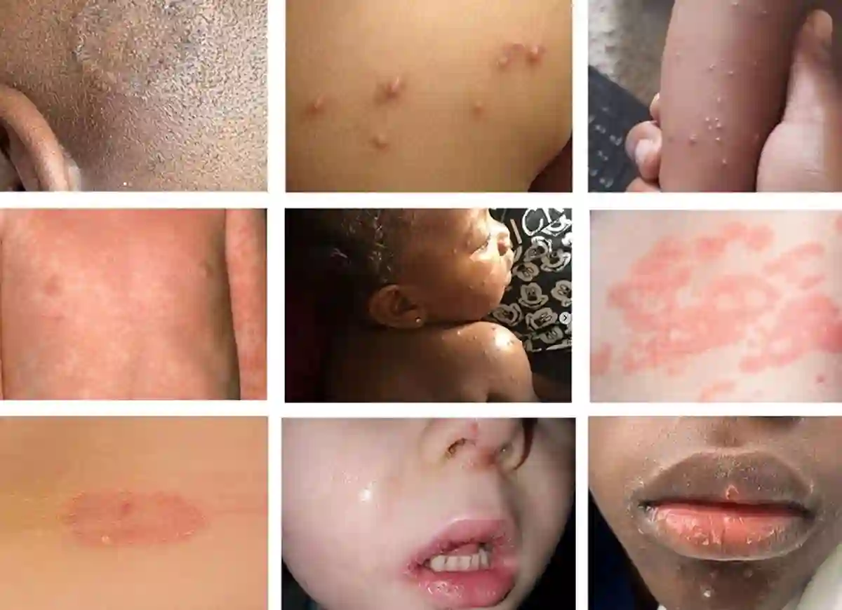 skin rash,bacterial skin rash,cancer skin rash,skin different kinds of rash,dry skin rash, what std can cause a skin rash,how to treat a skin rash,how to treat skin rash what std can cause a skin rash?,how to get rid of skin rash,heat rash,skin rash,rash,rash behind ear