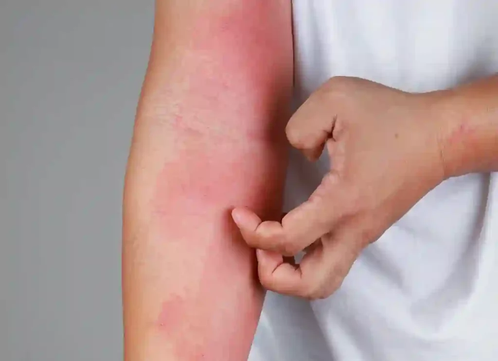 when to worry about a rash in adults,rashes on joints,medicines for rashes,how to get rid of face rash, rashe,rash behind ears and neck,stomach rash,rash on front of neck,ear rash,cream for rashes on body