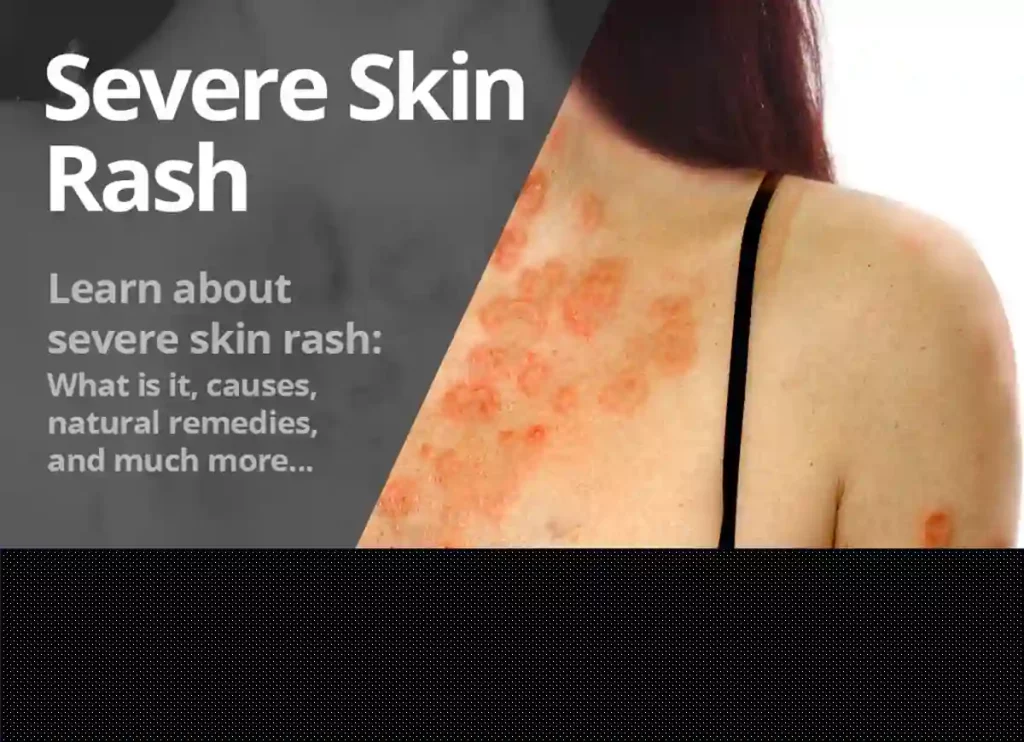 when to worry about a rash in adults,rashes on joints,medicines for rashes,how to get rid of face rash, rashe,rash behind ears and neck,stomach rash,rash on front of neck,ear rash,cream for rashes on body