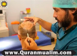 is hair transplant haram, hair transplant is halal or haram,is a hair transplant haram, hair transplant in islam ,are hair transplants haram, is hair transplant halal, hair weaving vs hair transplant